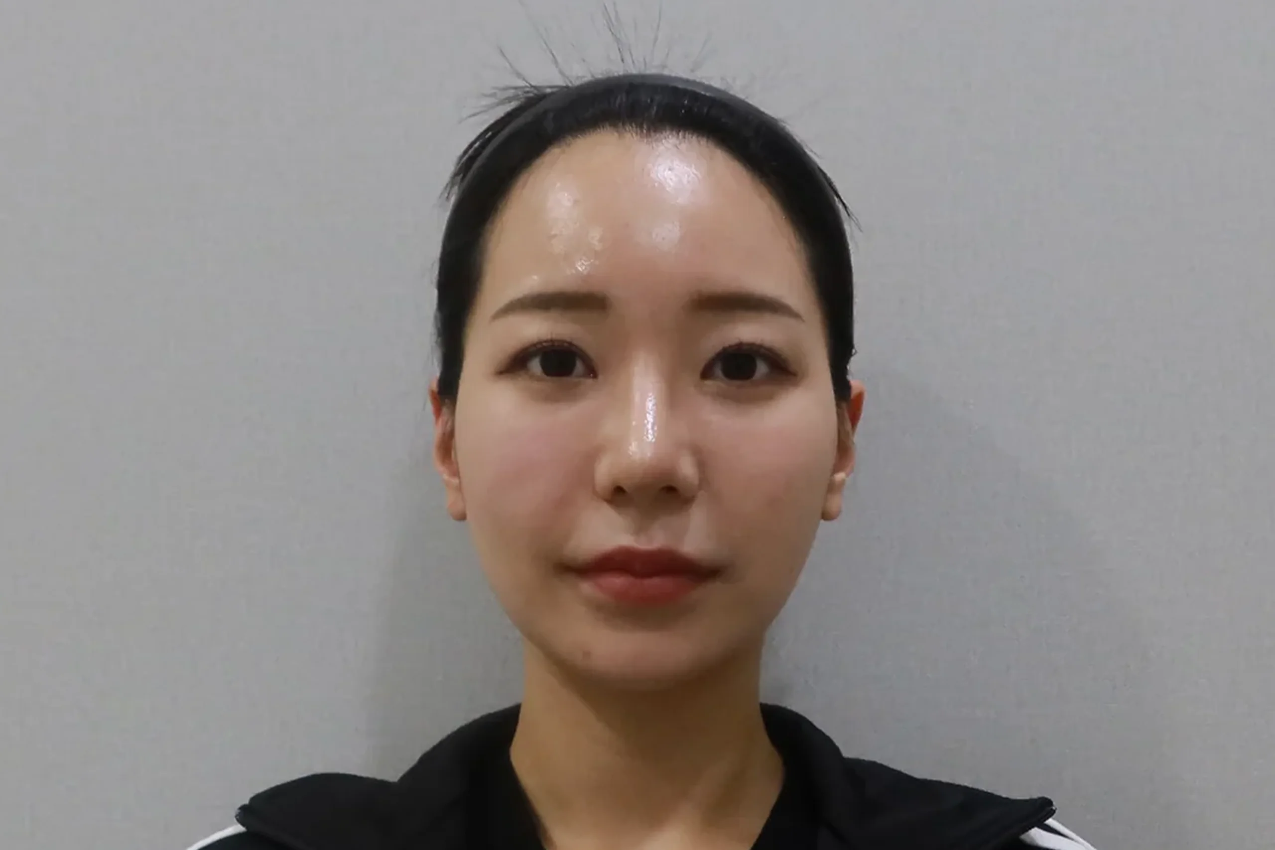 Front view after lip filler procedure