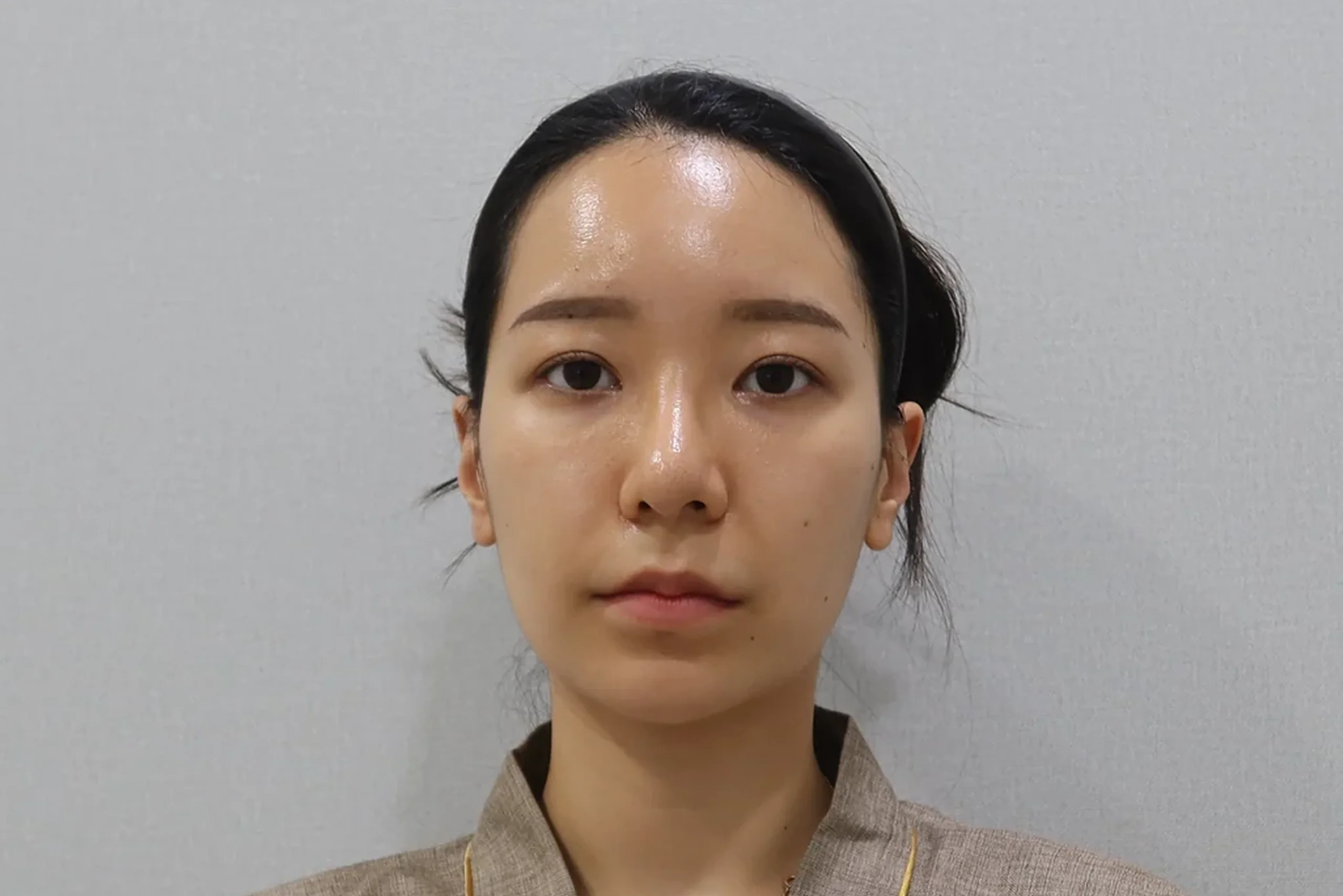 Front view before lip filler treatment