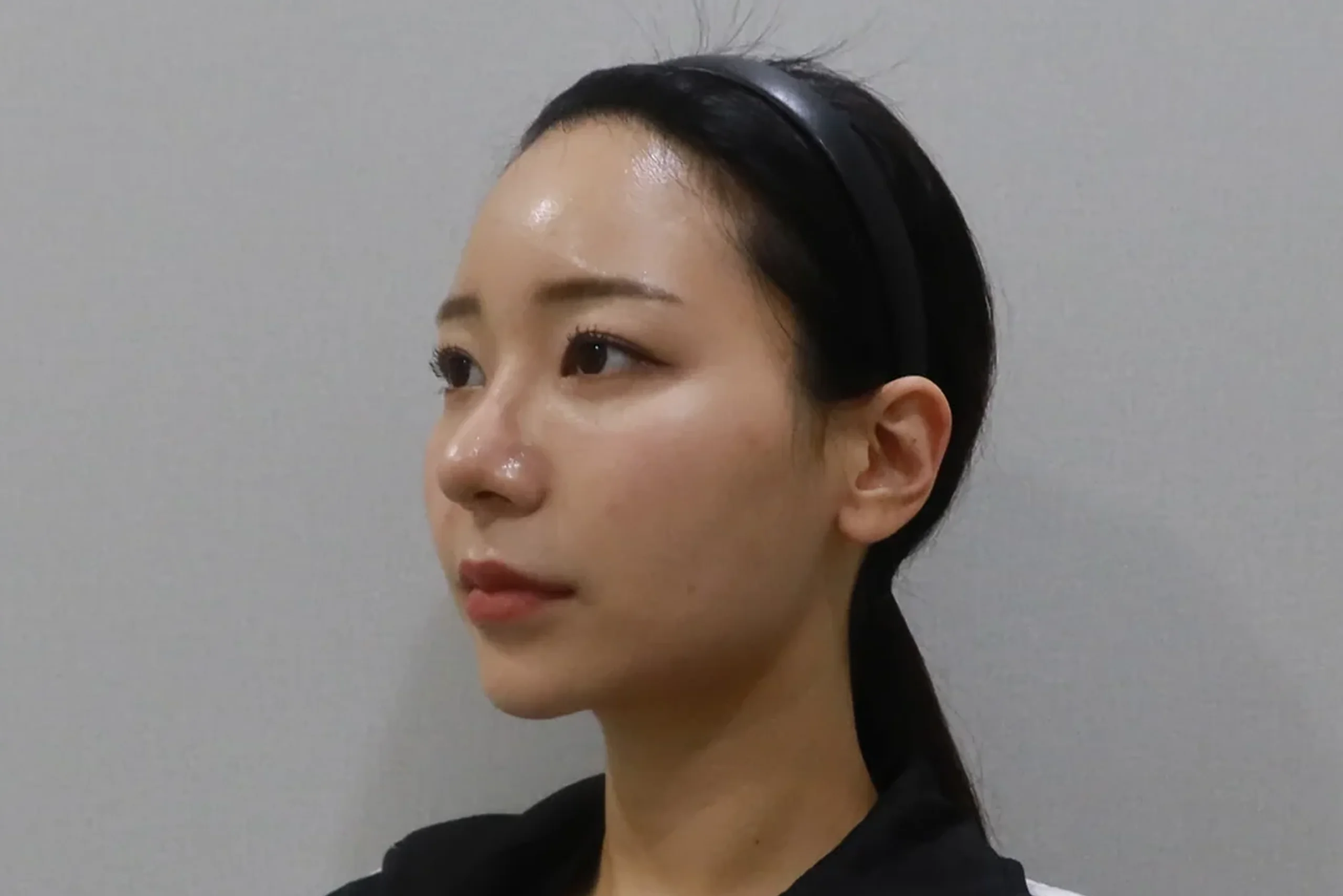 Half-lateral view after lip filler treatment