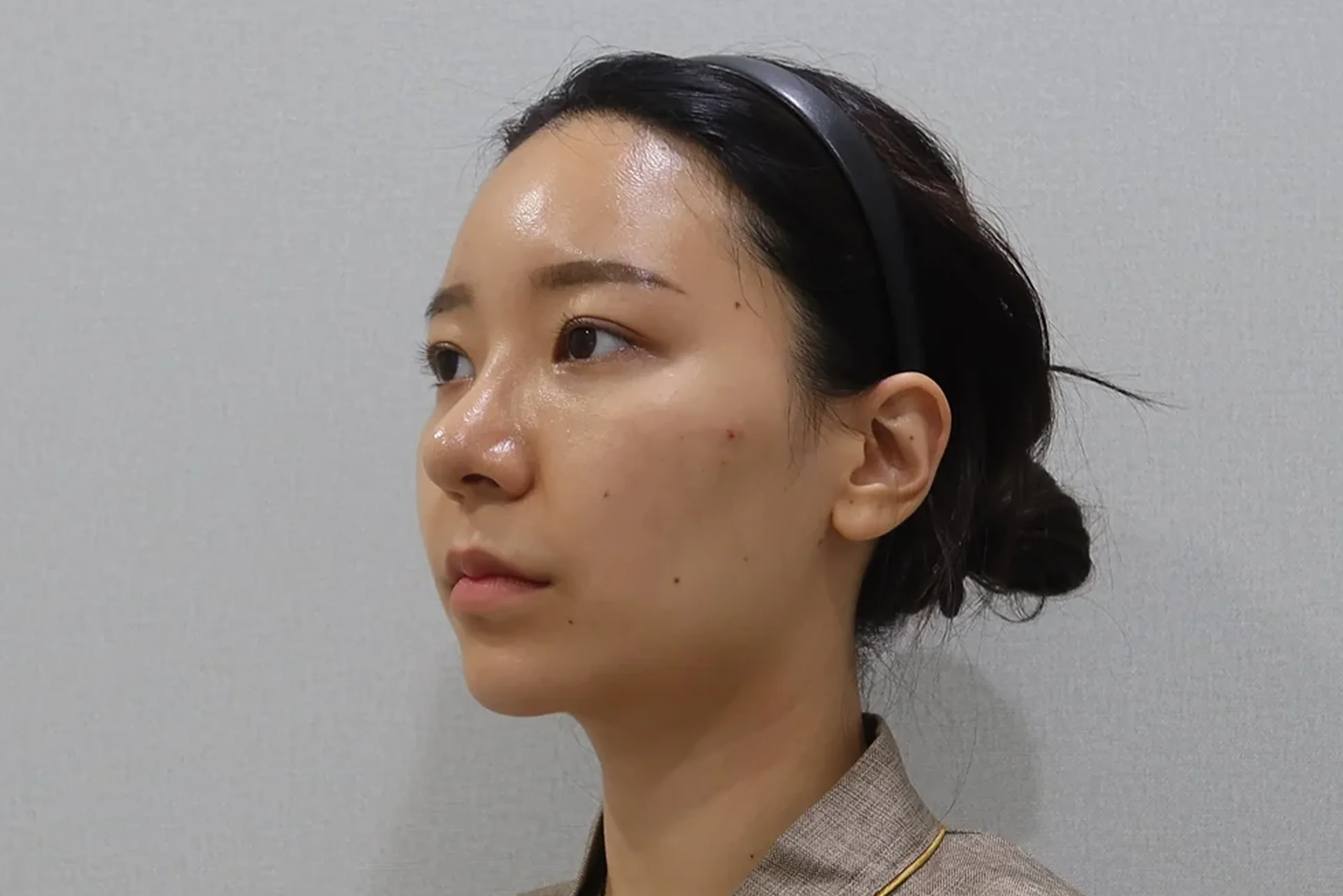 Half-lateral view before lip filler treatment