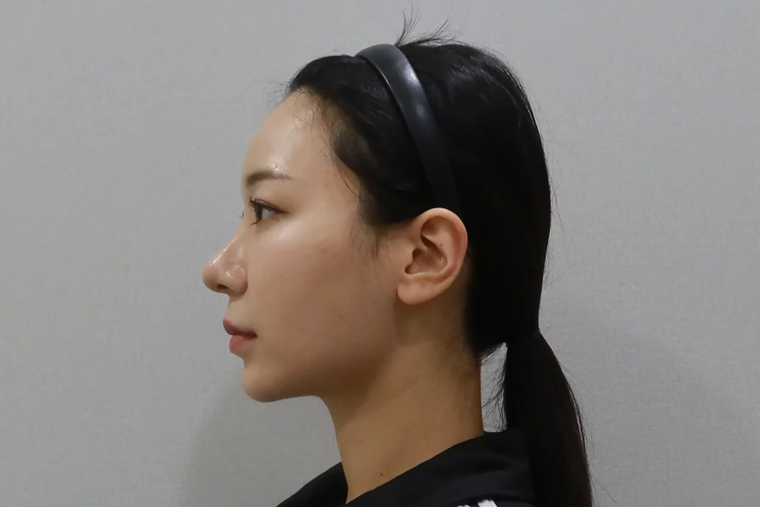 Lateral view after lip filler procedure