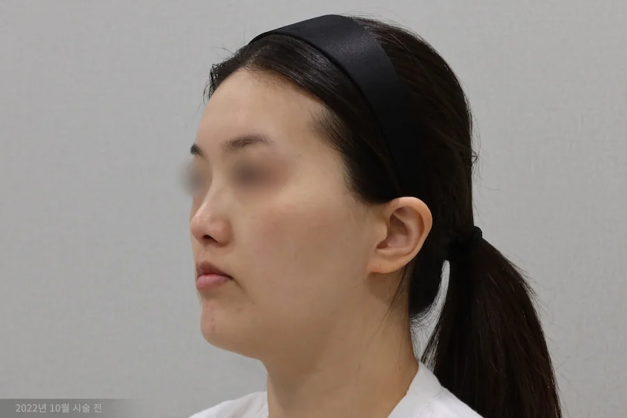 Hemilateral case before titanium laser treatment