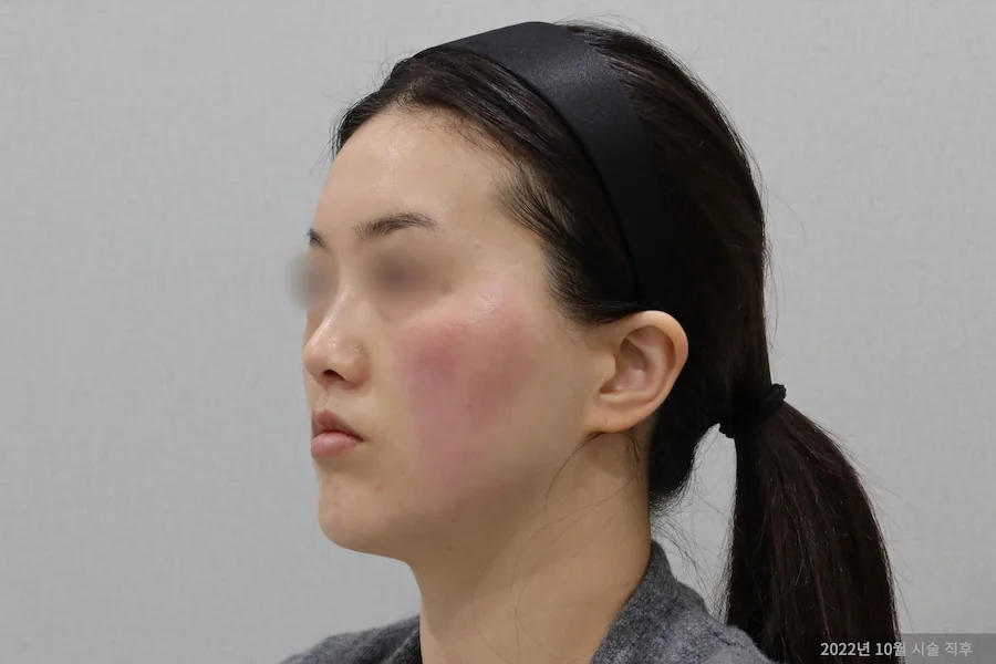 Dr.Eraser titanium laser treatment after hemifacial view