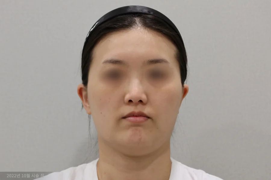 Frontal view before titanium laser treatment 1