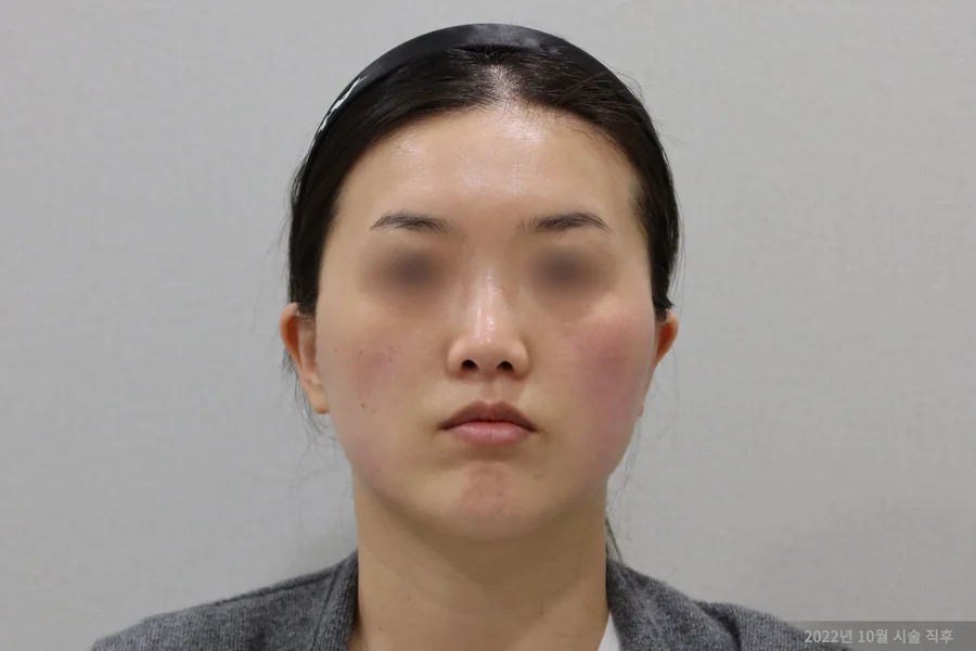 Frontal changes after titanium laser treatment 1