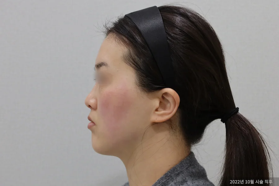 Lateral changes after erase circle titanium laser treatment