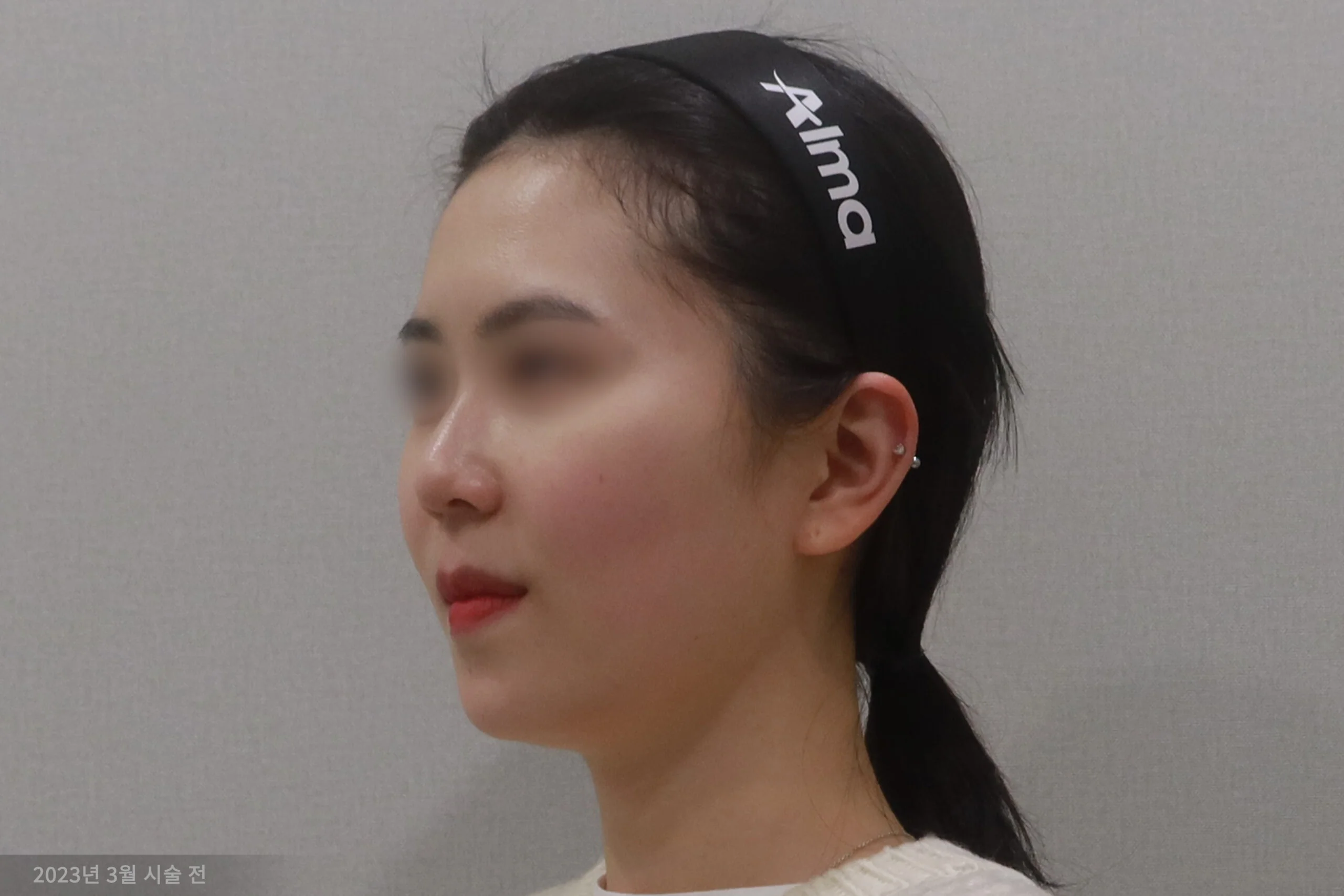 Half-lateral case before the facelift procedure