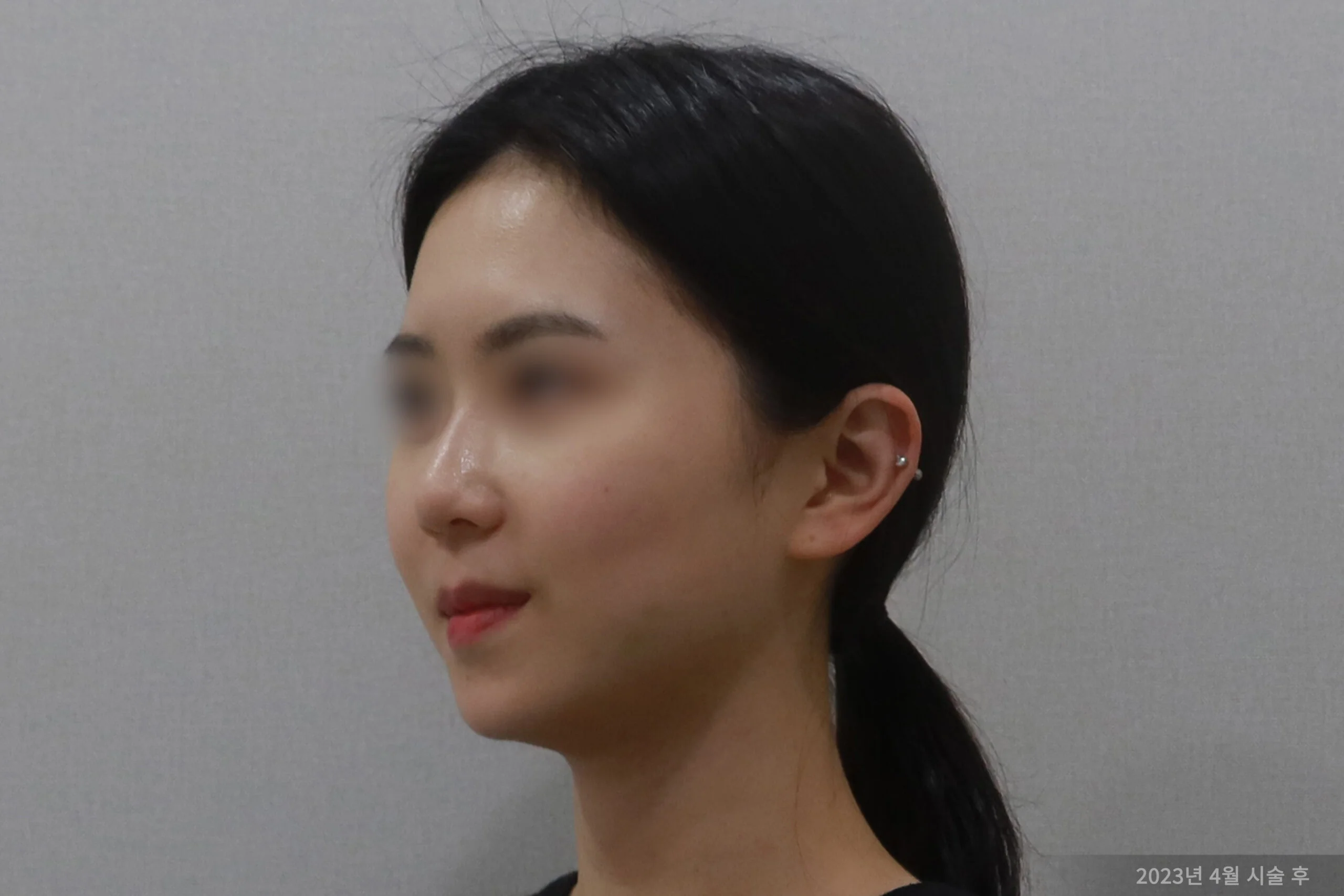 Hemifacial case after facelift procedure