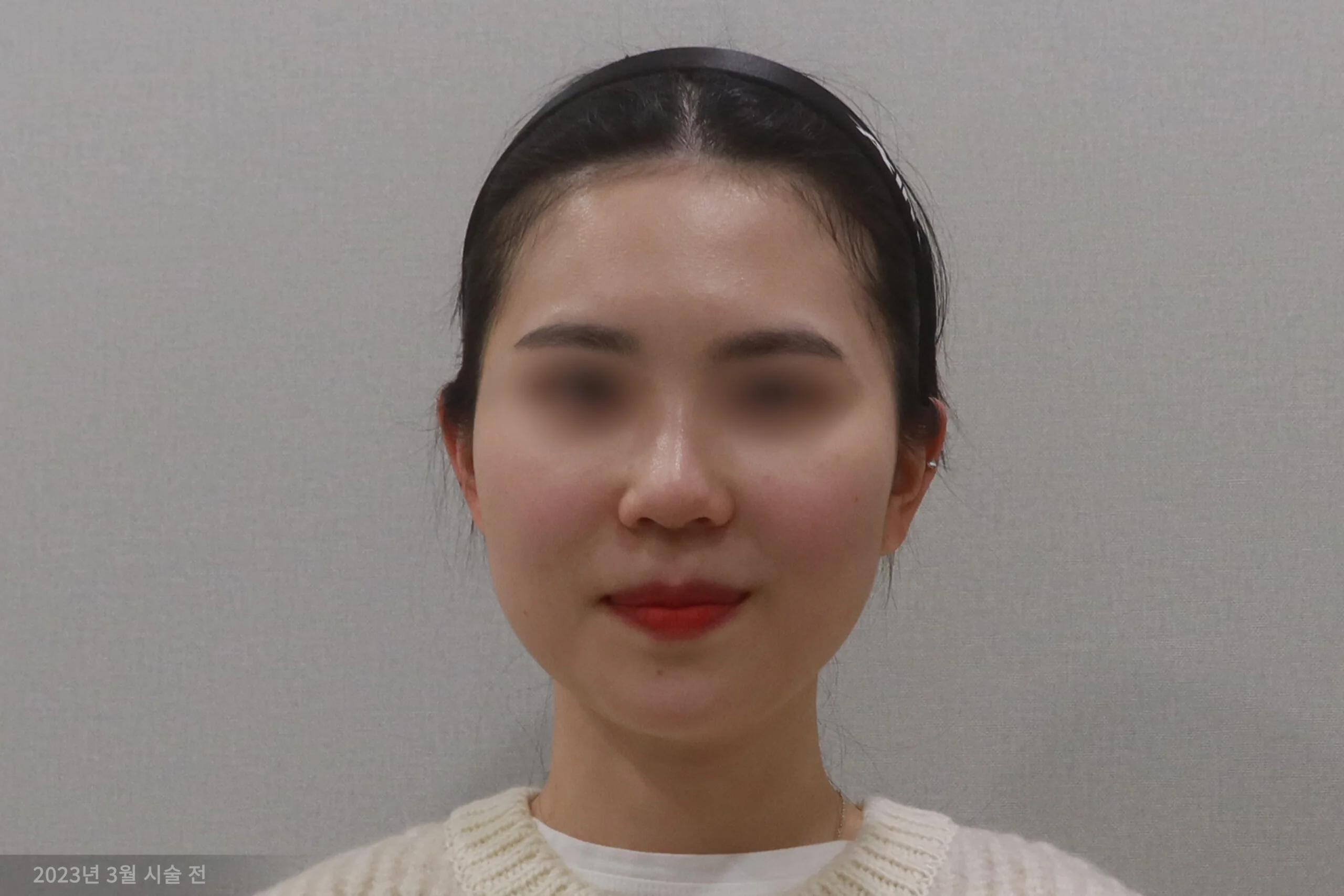 Frontal example before the facelift procedure