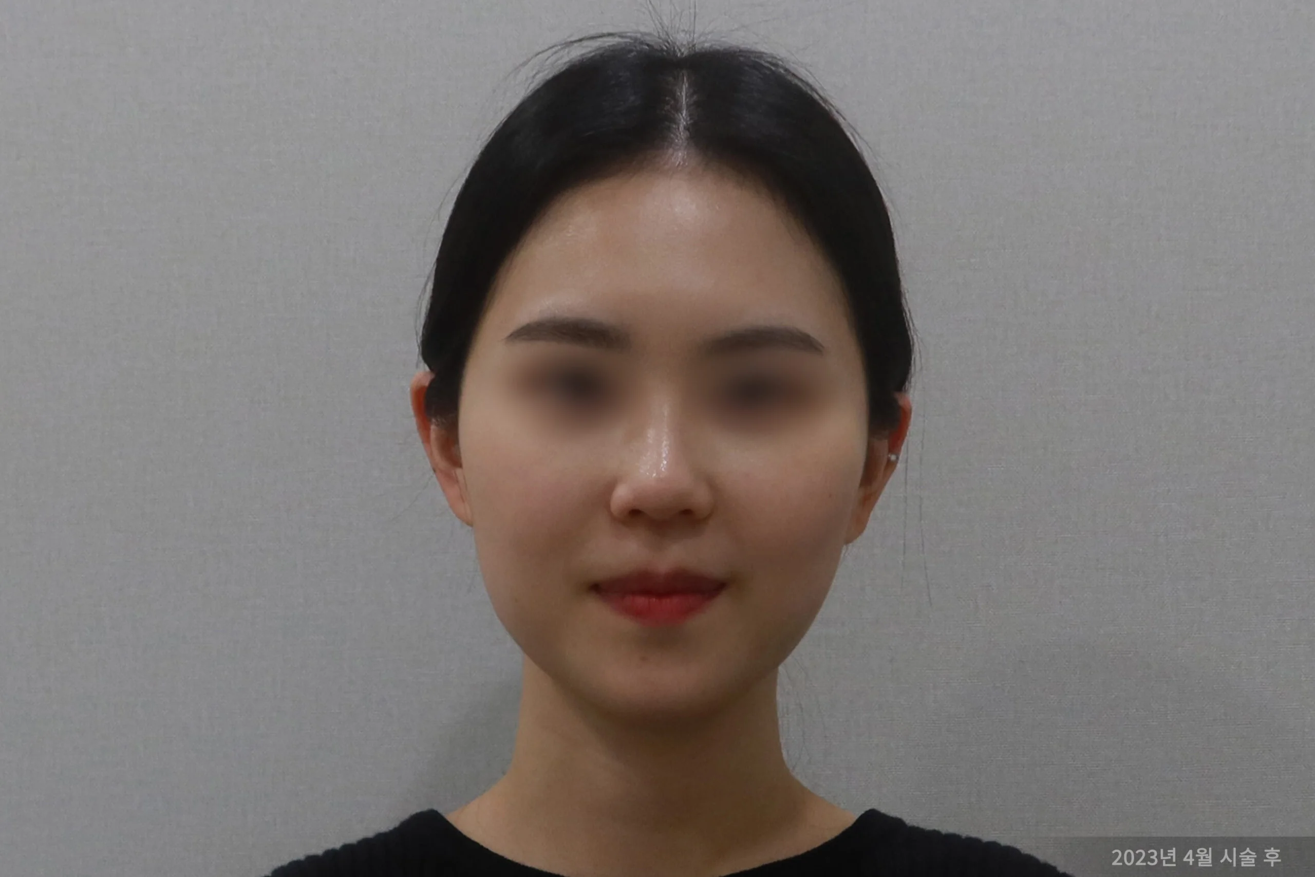 Frontal example after a facelift procedure