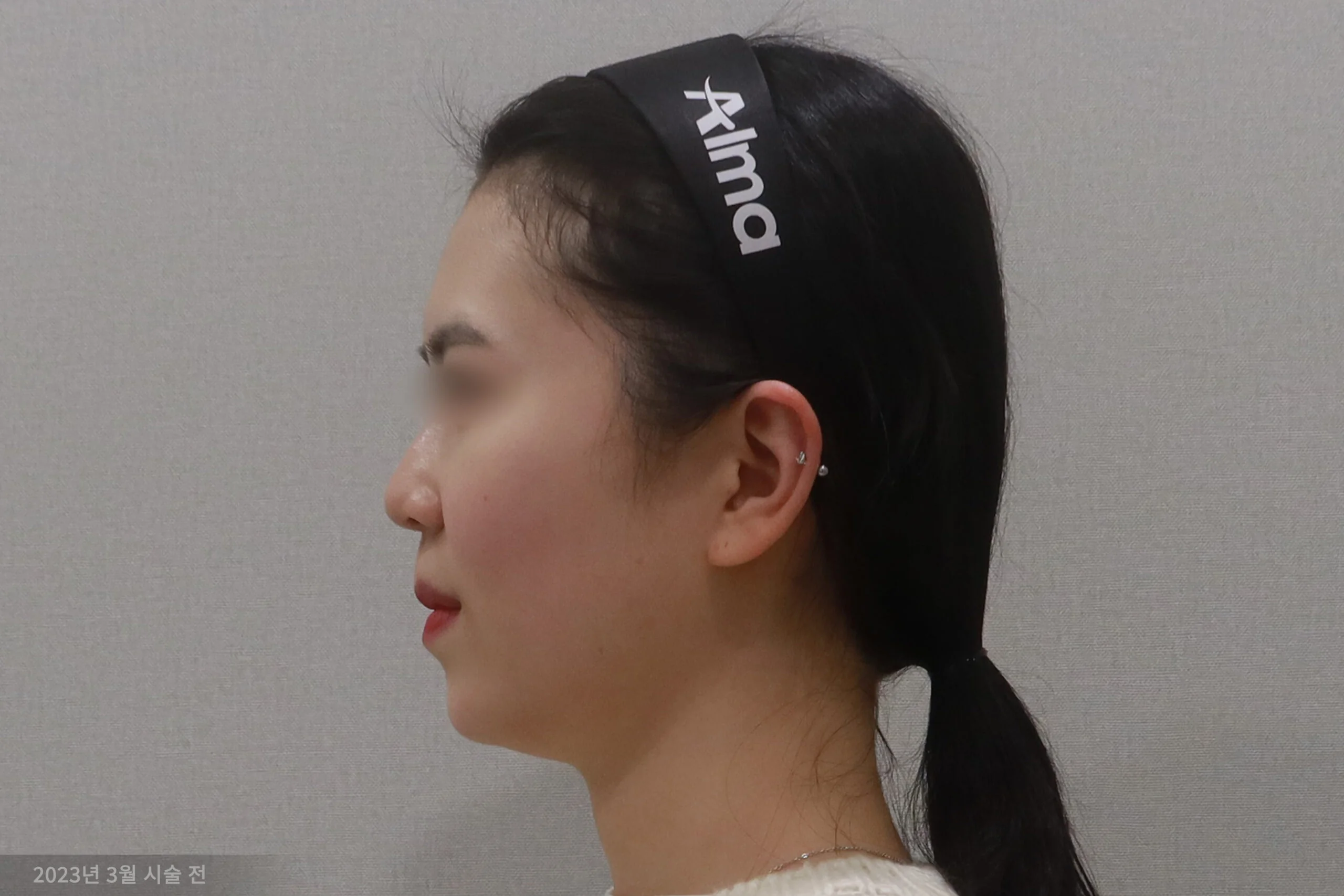 Lateral view before the facial eraser procedure