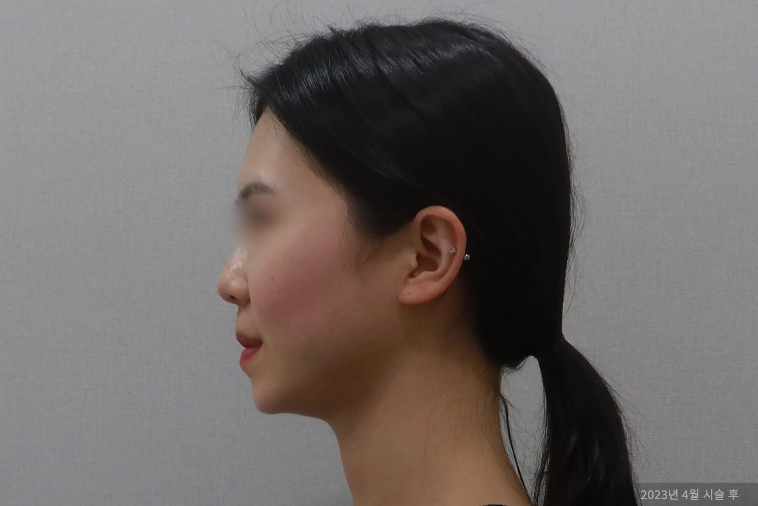 Lateral case after facelift procedure