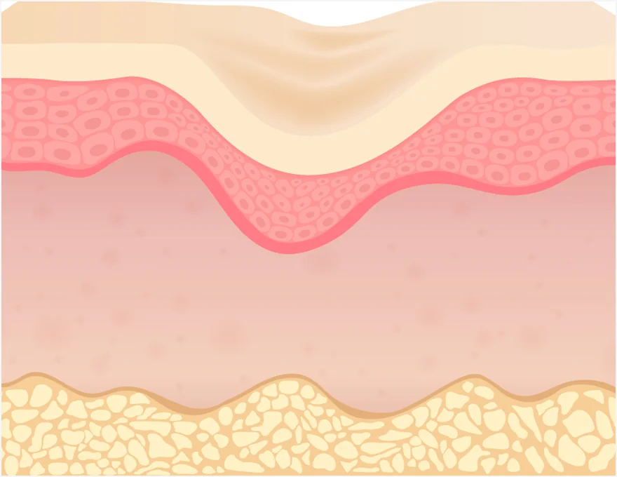 Collapsed skin layers before Retigen treatment