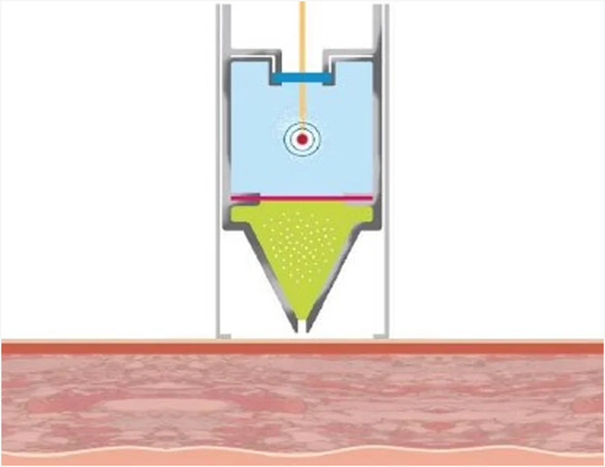 How the Mirage Jet Procedure Works Step 1