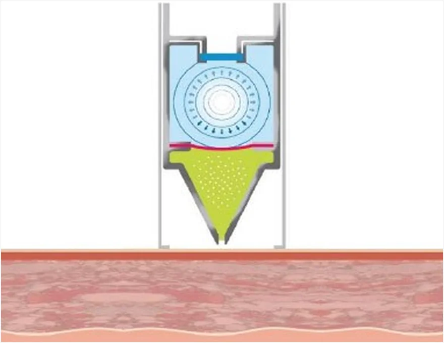 How the Mirage Jet Procedure Works Step 2