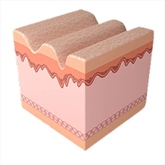 Mirage Jet Procedure 1