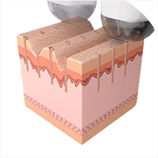 Mirage Jet Procedure 2