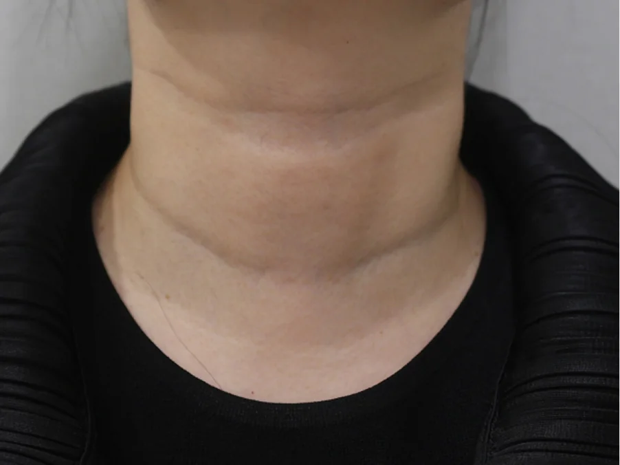 Necklisset Neck Wrinkle Eraser pre-procedure before photo 1 Case 1