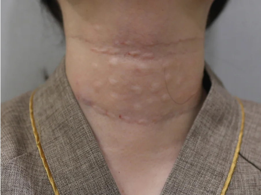 Post Nexiset Neck Wrinkle Eraser treatment before and after photo 1 Case 1