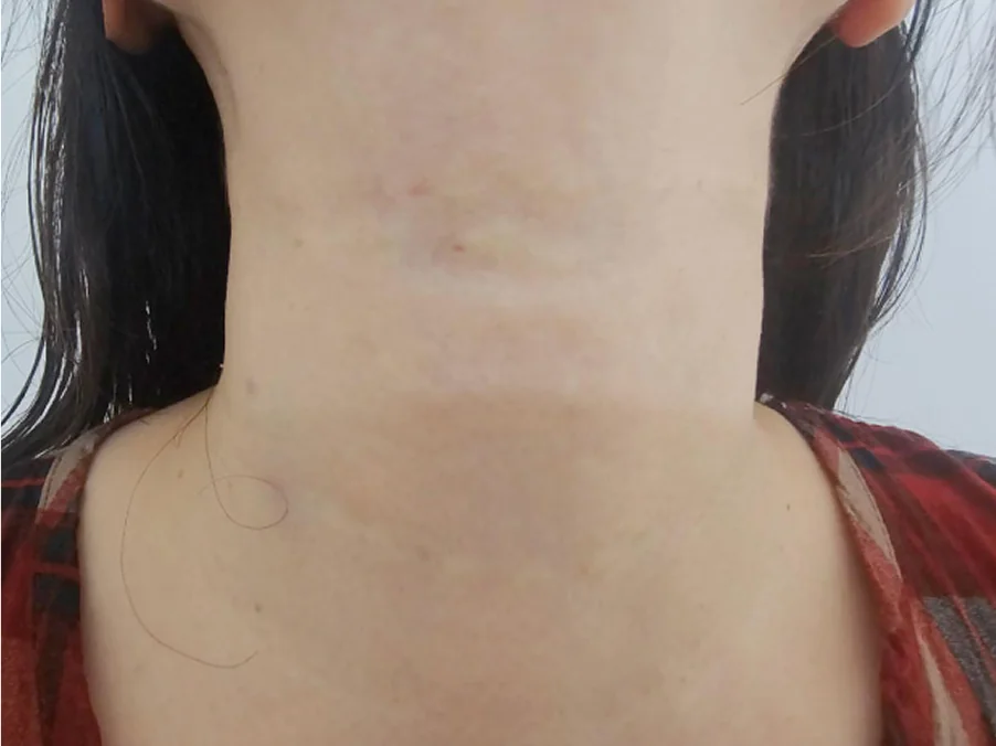 Nexyset Neck Wrinkle Eraser treatment day 5 progress photos Case 1