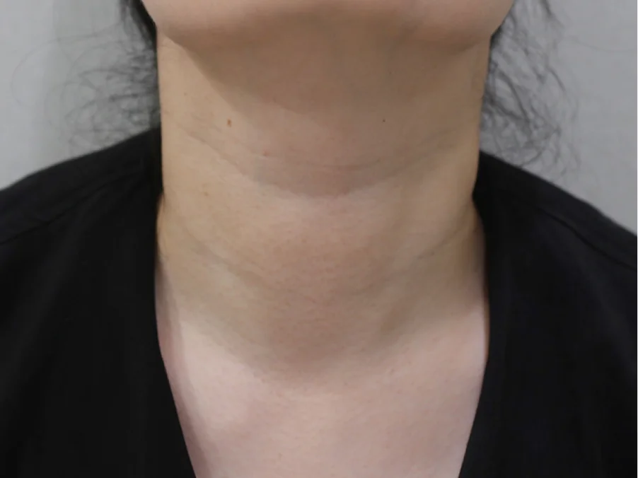 Necklisset Neck Wrinkle Eraser pre-procedure before and after photo Case 2