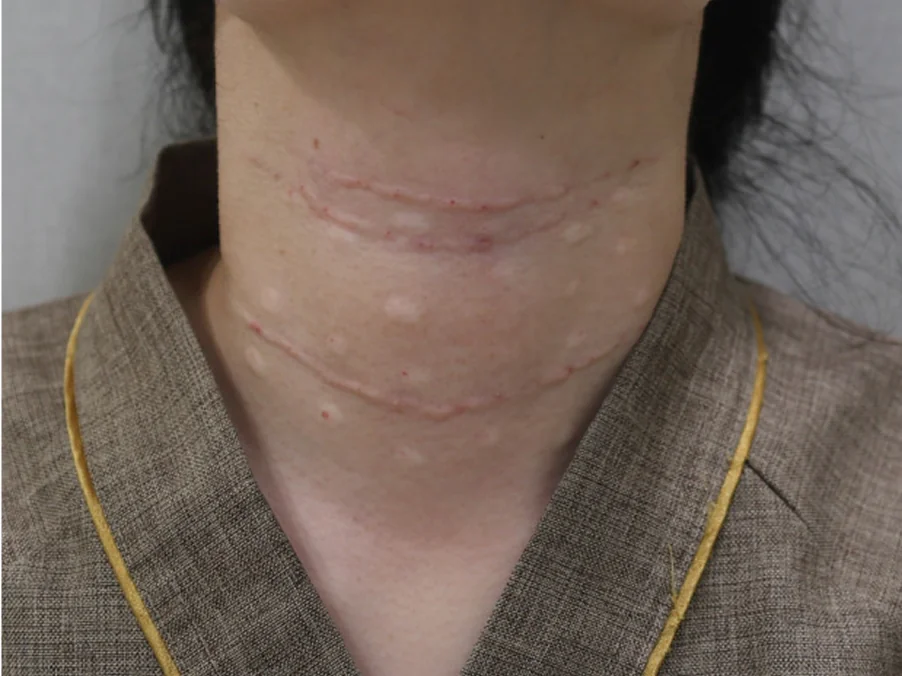 Case 2 after the Necklisset Neck Wrinkle Eraser procedure.