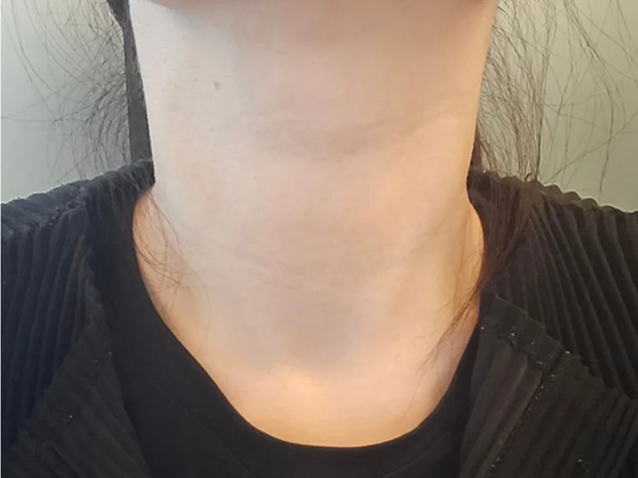 Nexyset Neck Wrinkle Eraser treatment day 5 progress photo case 2