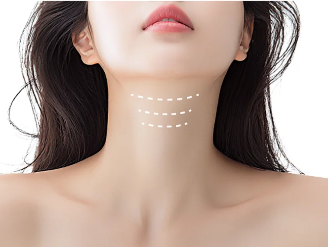 Type 1 neck wrinkle cases that can be improved with Necklisset