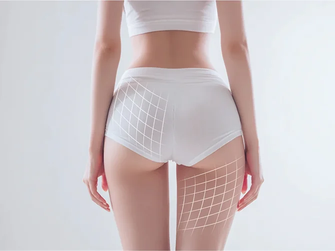 Cellulite reduction effects