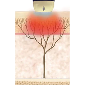 SHR mode - shrinks pores, improves skin texture, and reduces fine lines