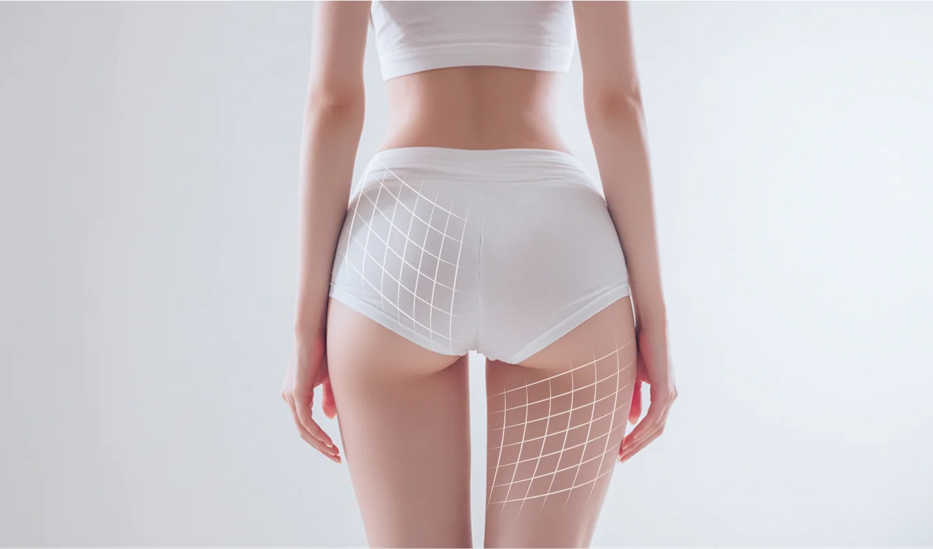 Cellulite reduction visuals