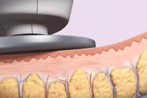 Selective Fat Destruction System