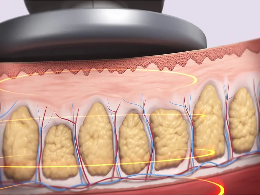 Pre-procedure fat cell status
