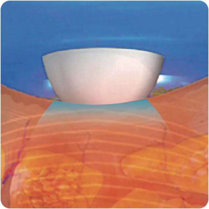 TuneFace Ice Contact Cooling for Painless Procedures