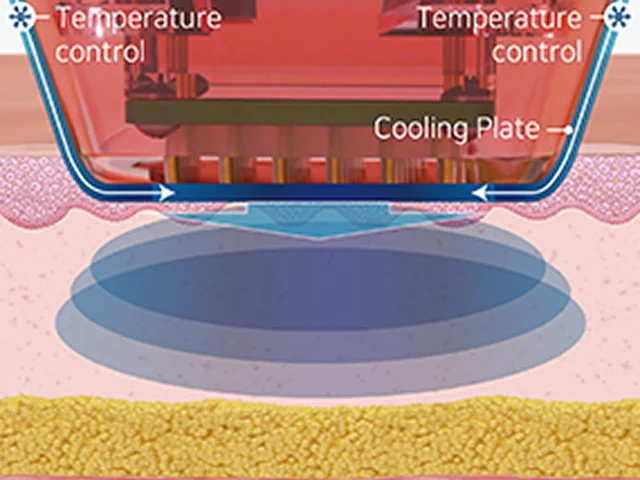 Advanced Cooling System for Eye virtue RF Procedure Phase 1
