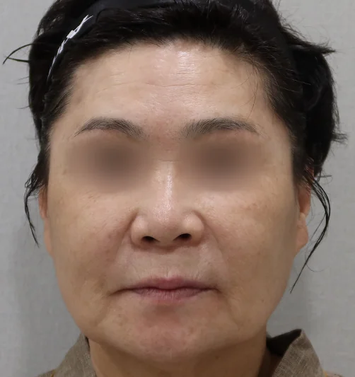 Frontal view before titanium laser treatment 2