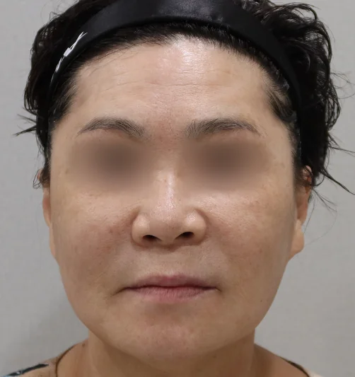 Frontal changes after titanium laser treatment 2