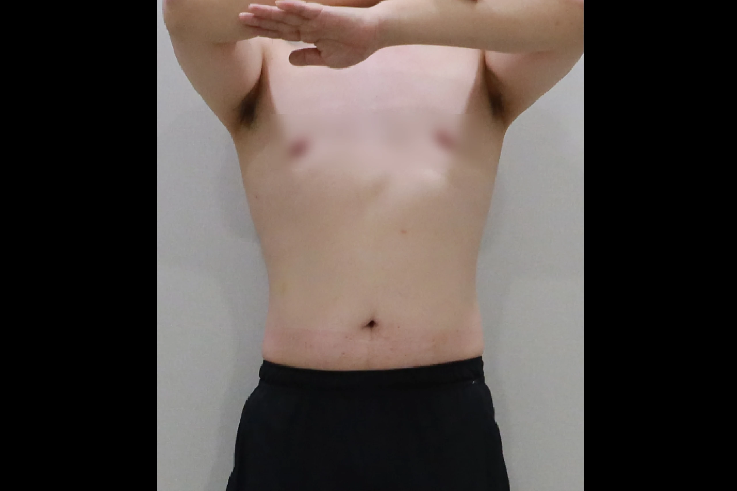 Full body results after a full body liposuction procedure