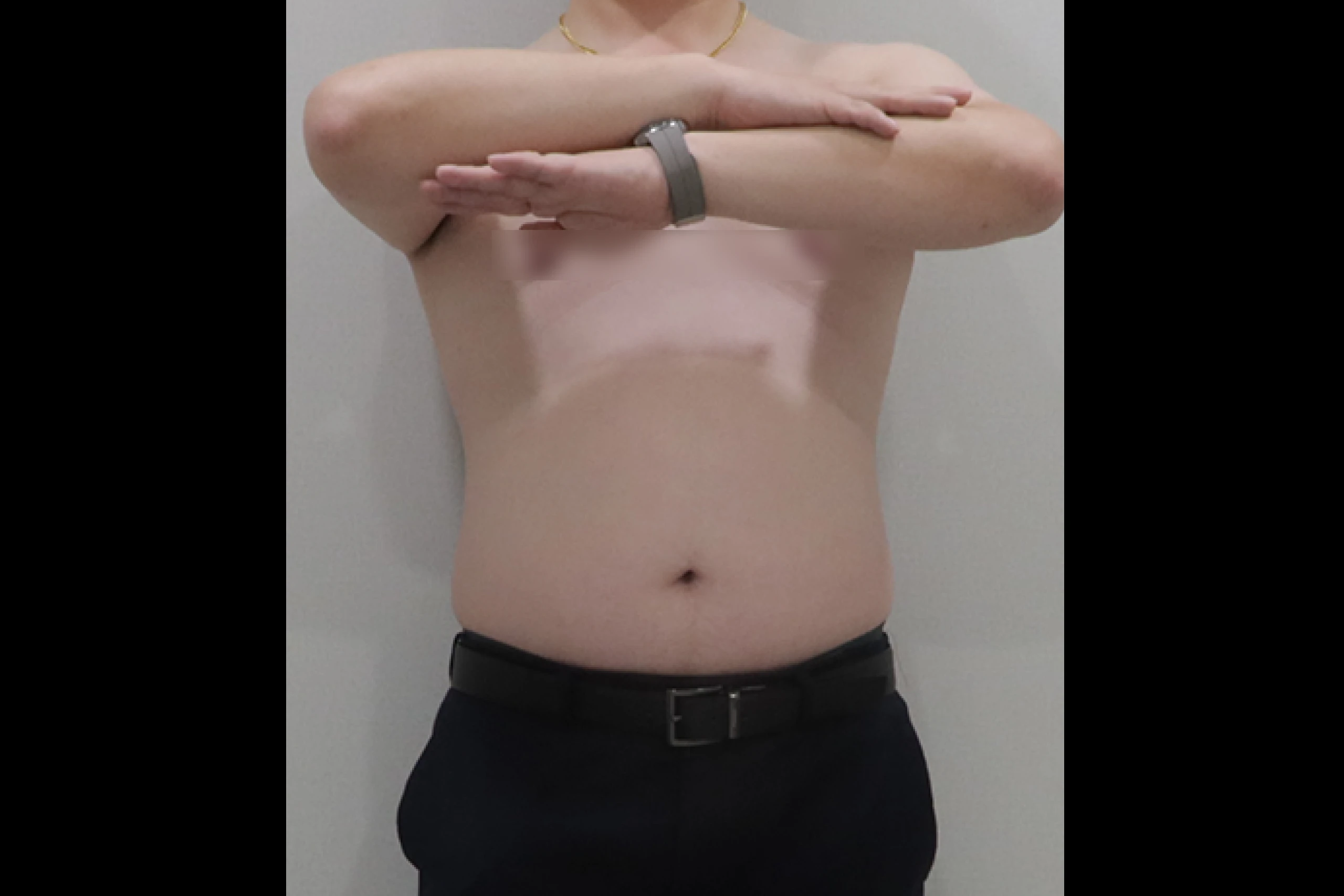 Full body photo before the full body sculpting procedure