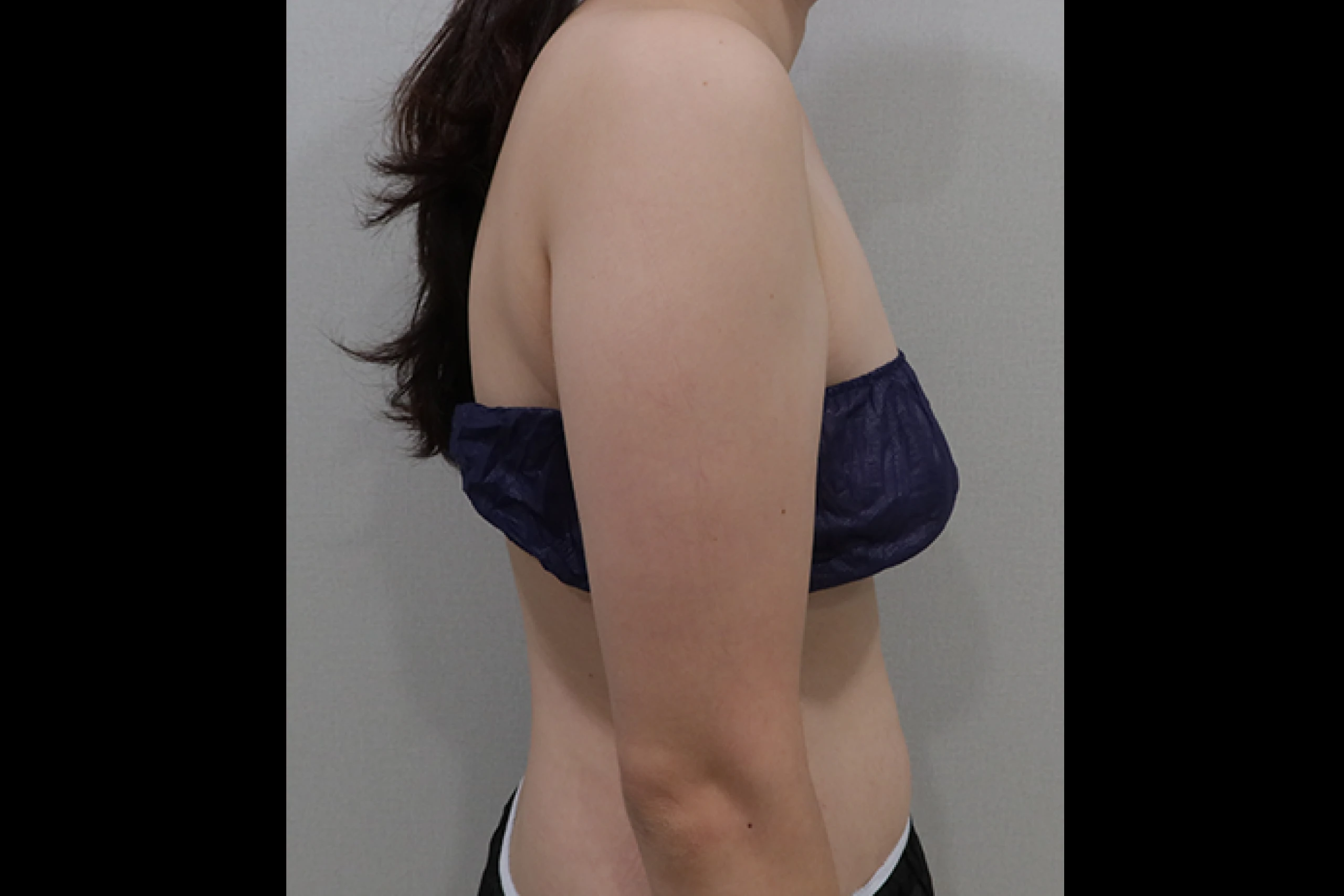 Side view before body titanium laser treatment 01