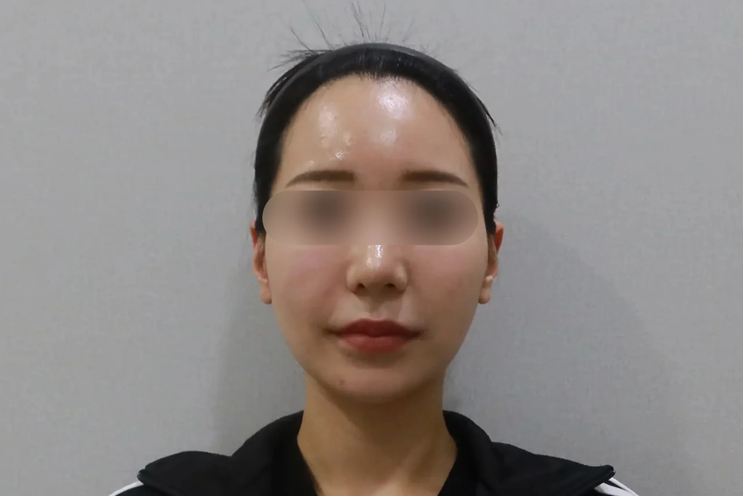 Dr.Eraser lip filler before front view