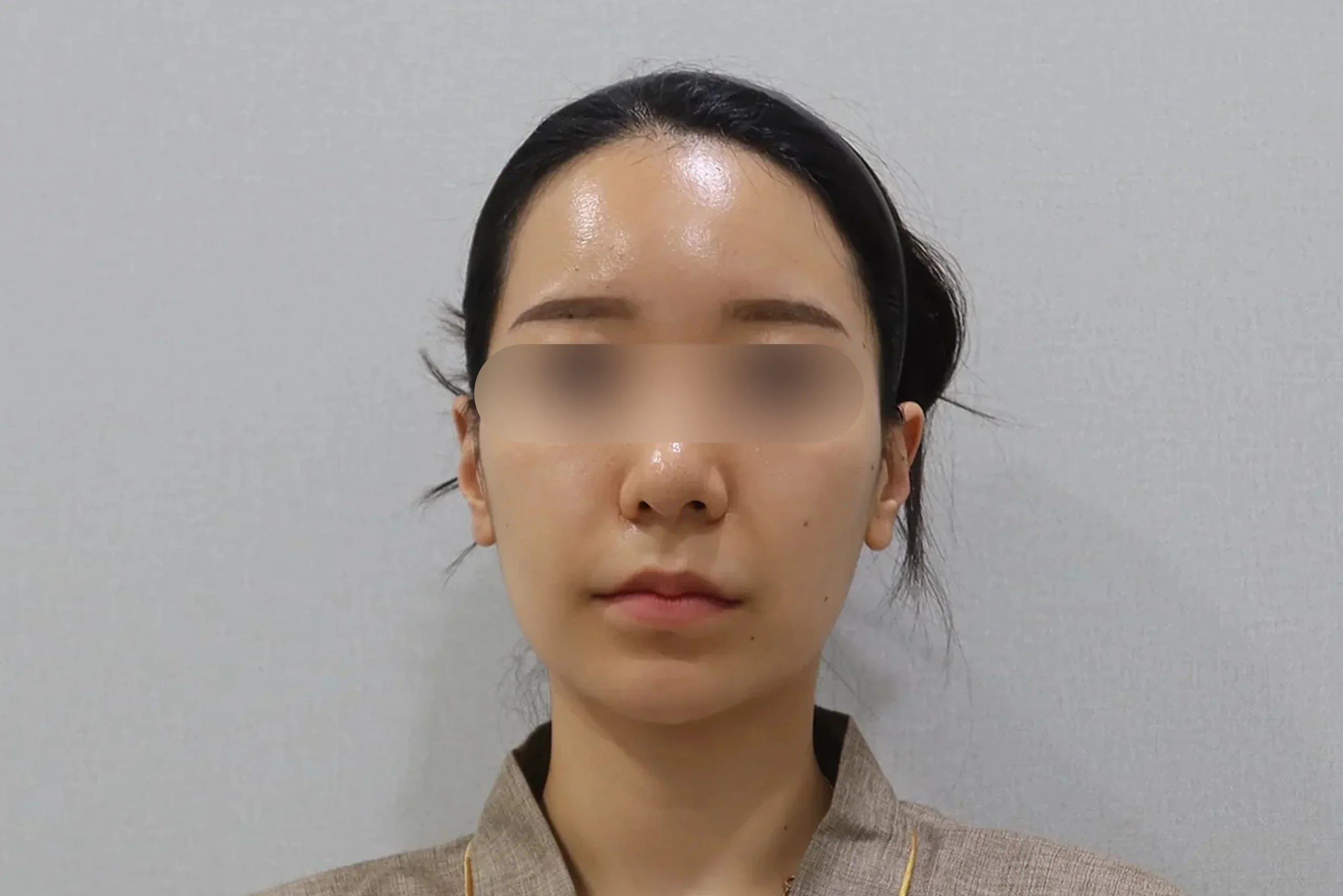 EraserFront view after circle lip filler