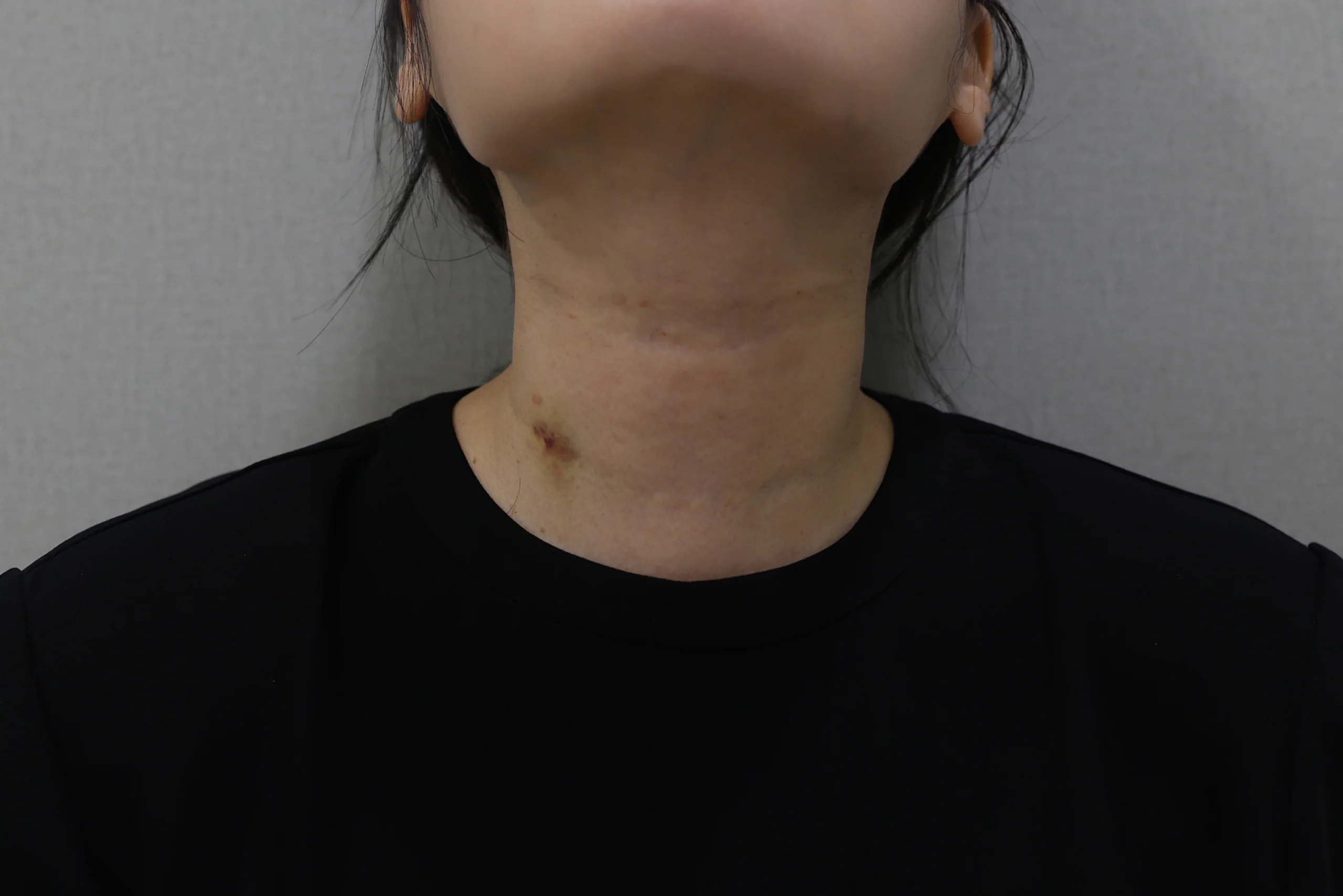 Before and after photos of the Necklisset Neck Wrinkle Eraser procedure.