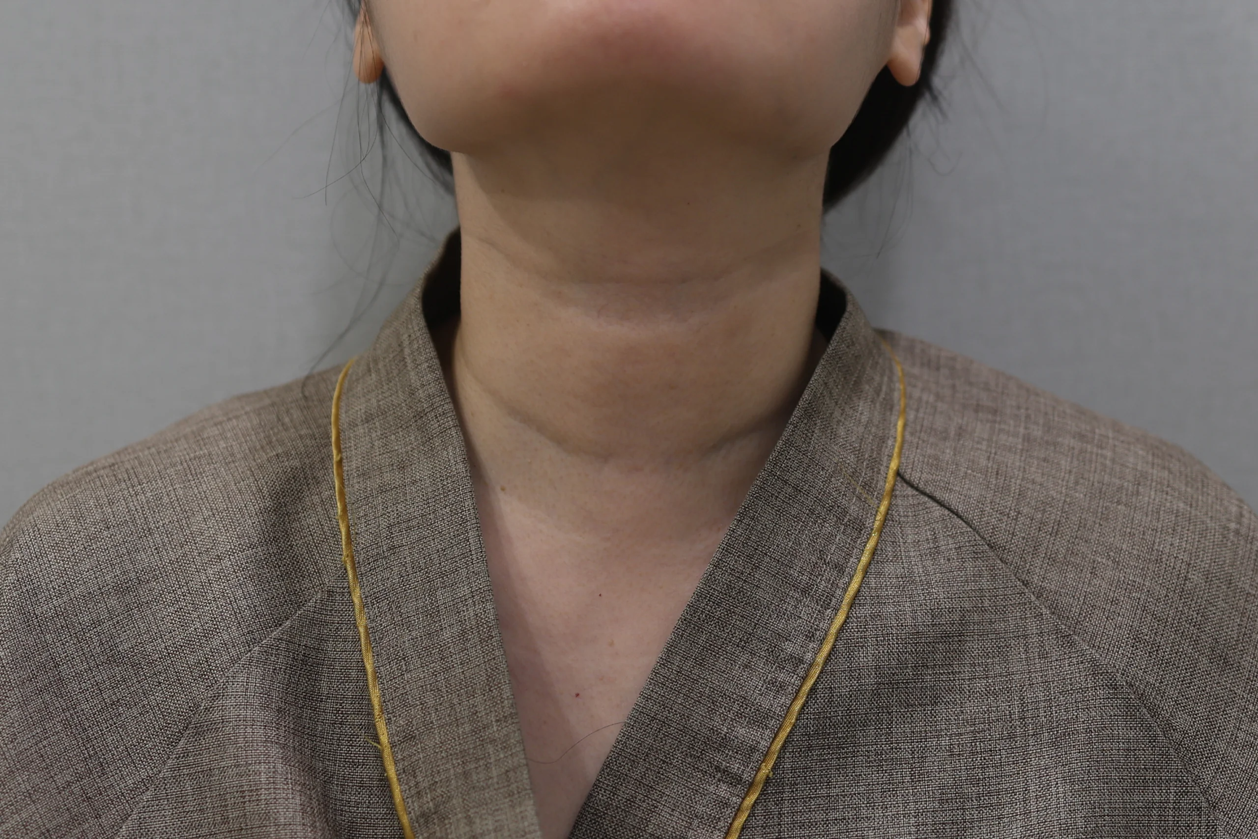 Before and after photos of Necklisset Neck Wrinkle Eraser treatment