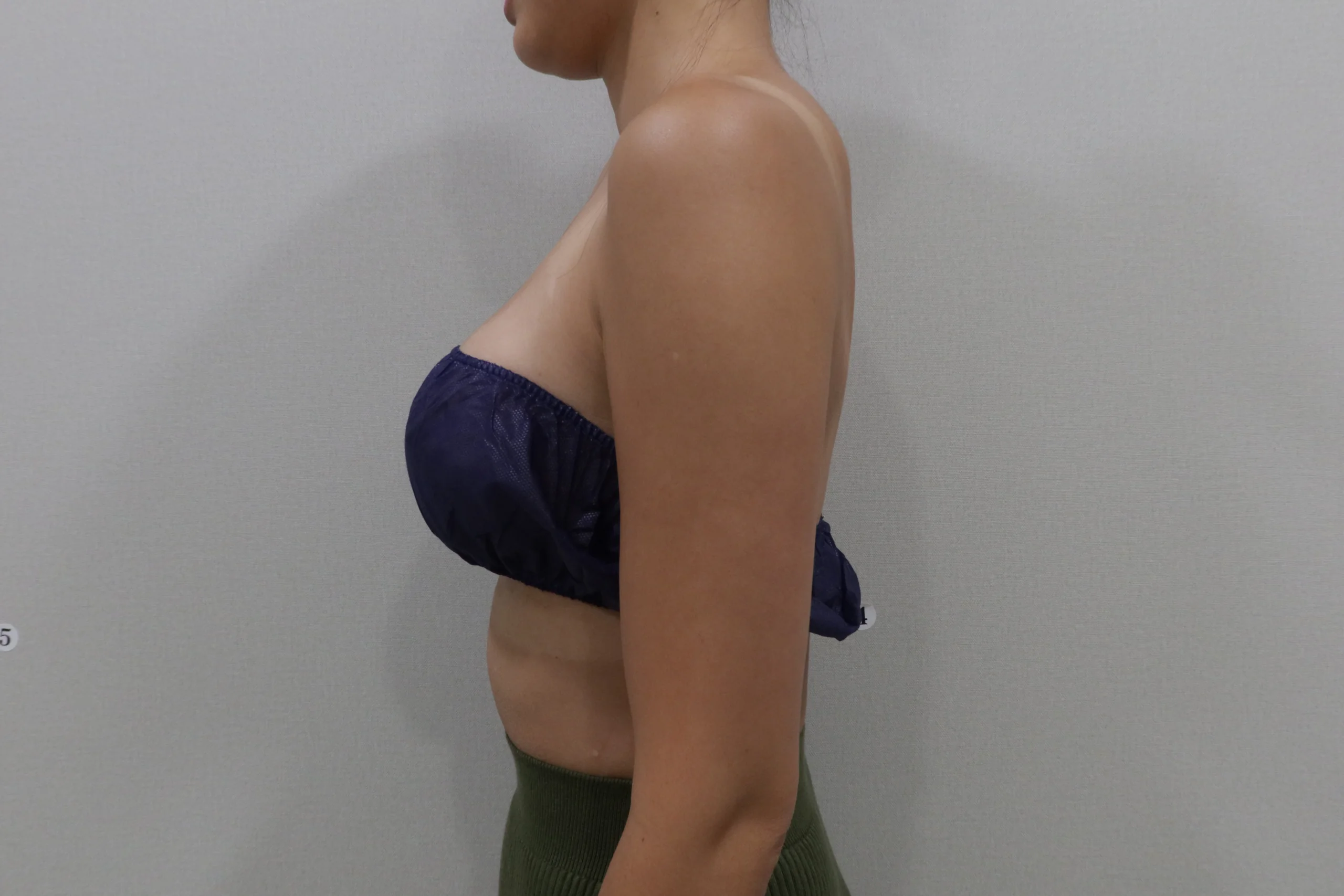 After Premium TuneBody Forearm Treatment