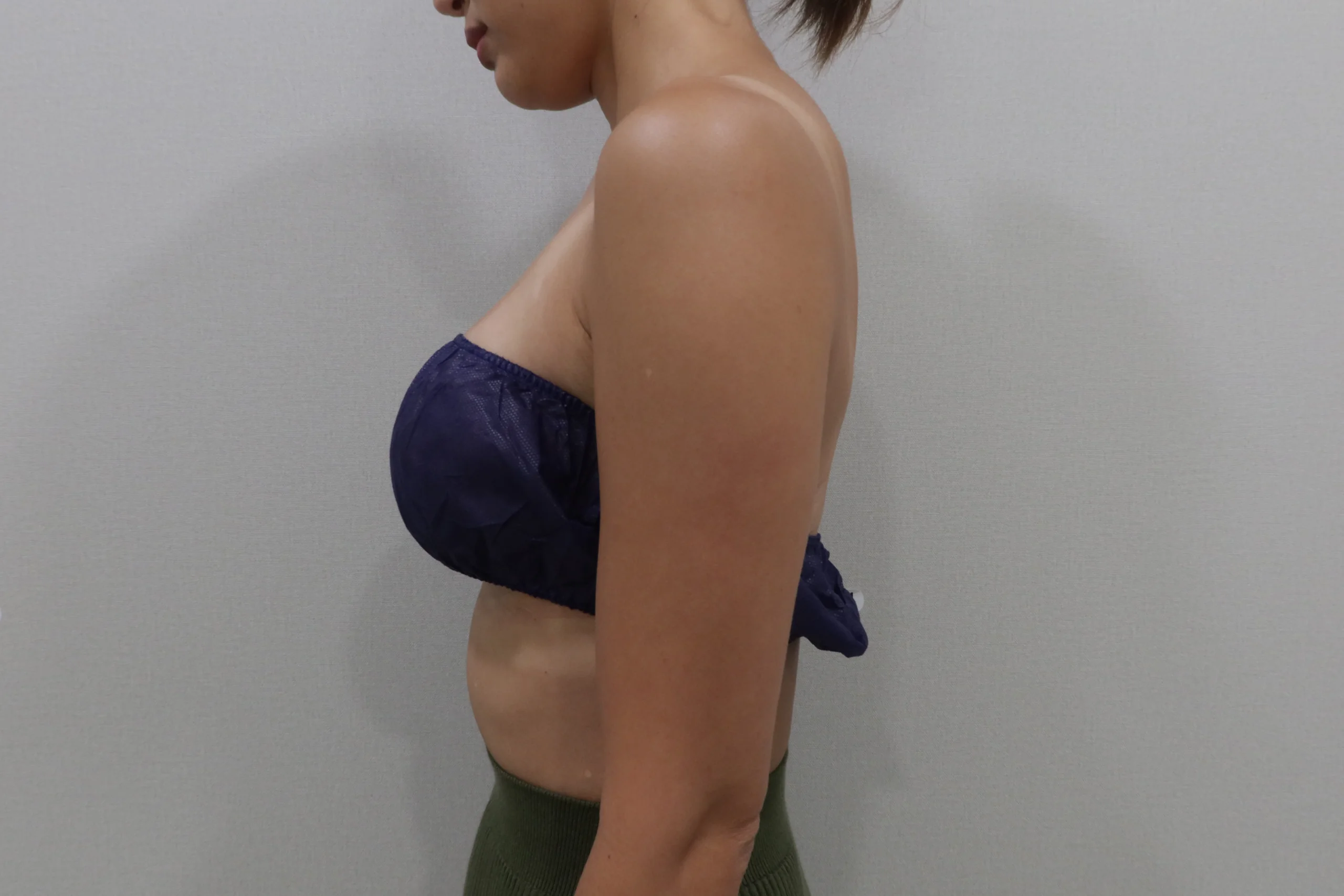 Before Premium TuneBody Forearms