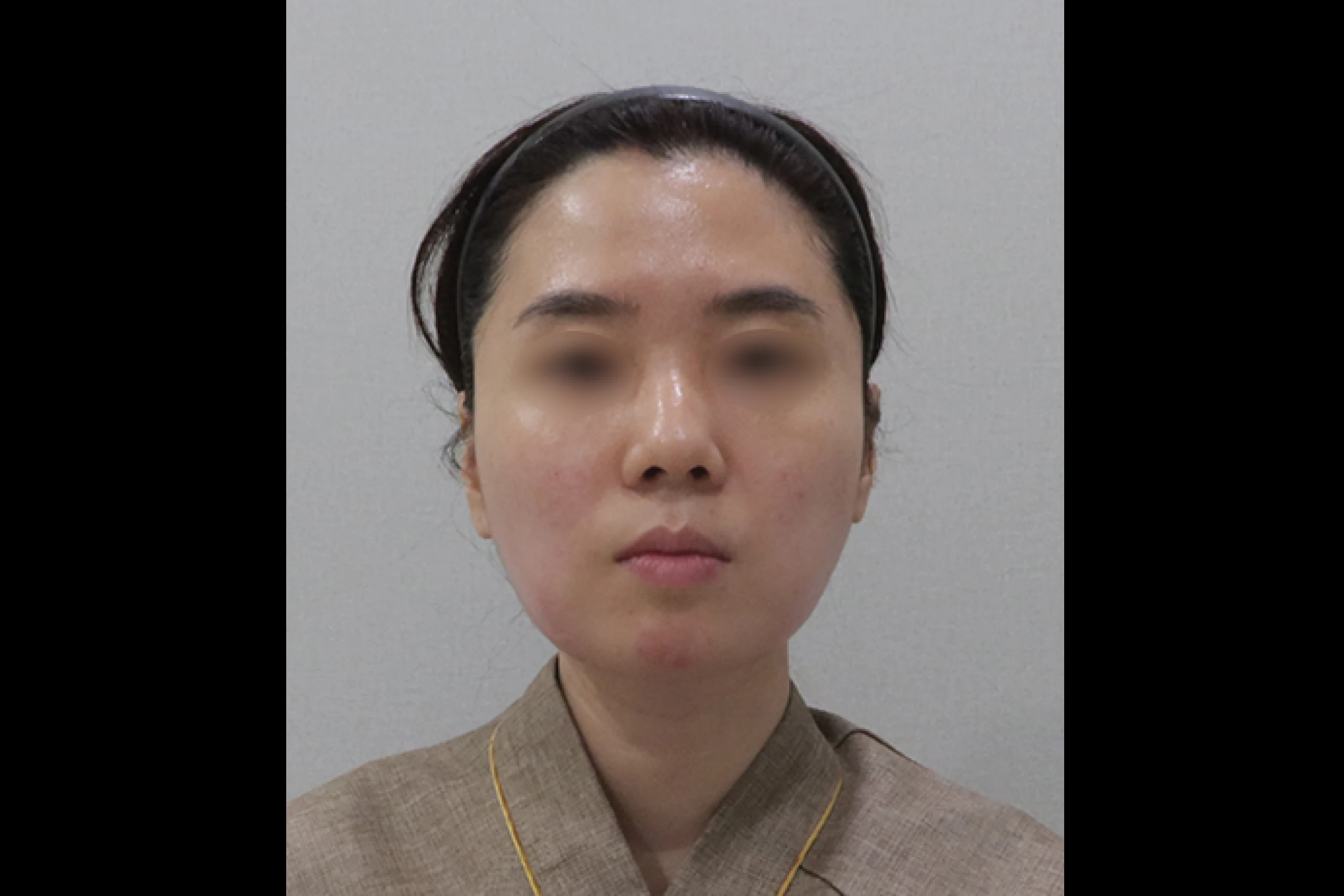 Improved V-line frontal appearance after TuneLiner TuneFace treatment