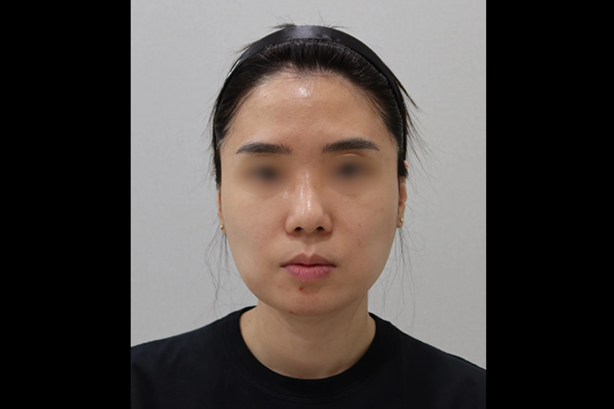 Frontal face before TuneLiner TuneFace procedure