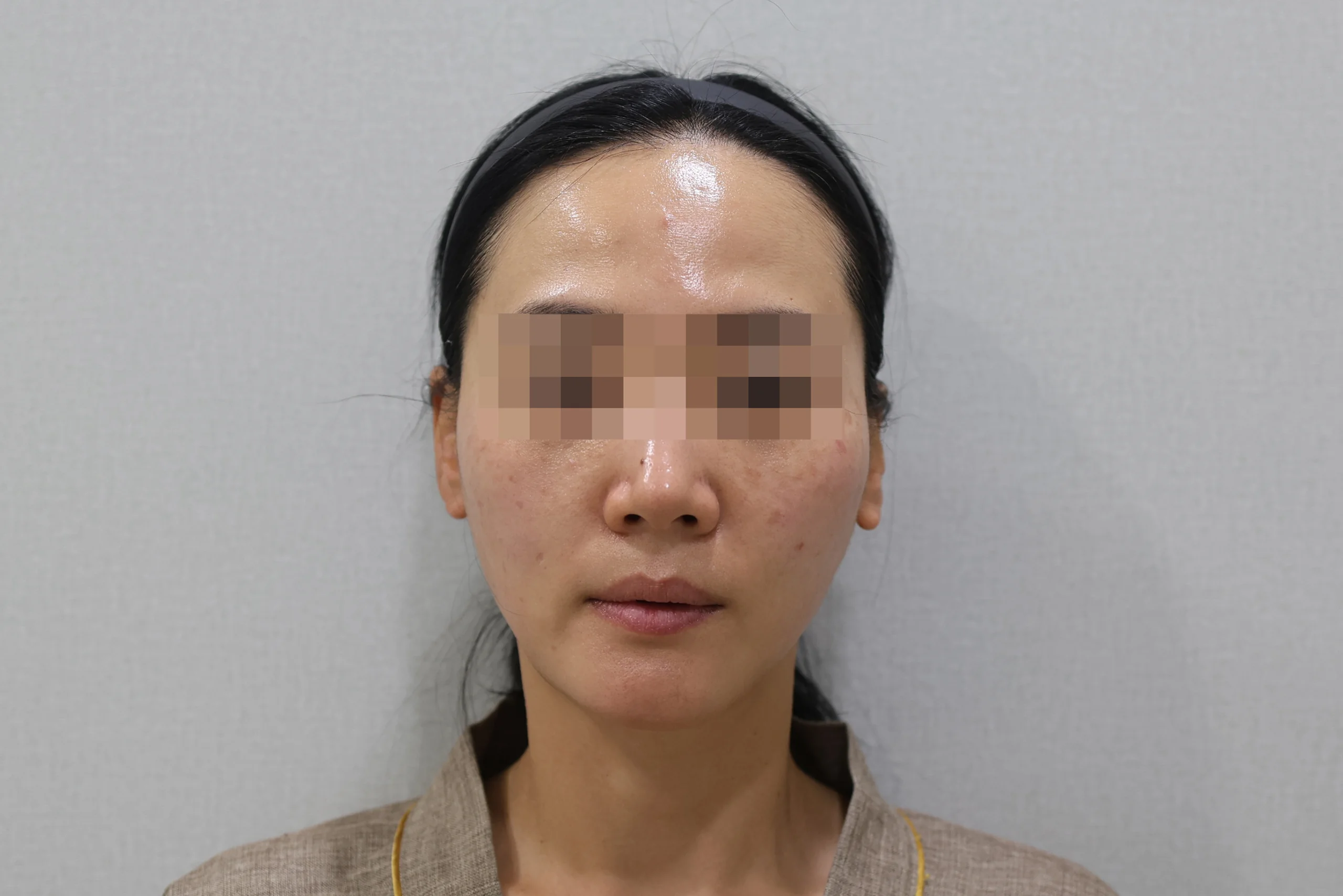 Frontal view 1 after XERF treatment