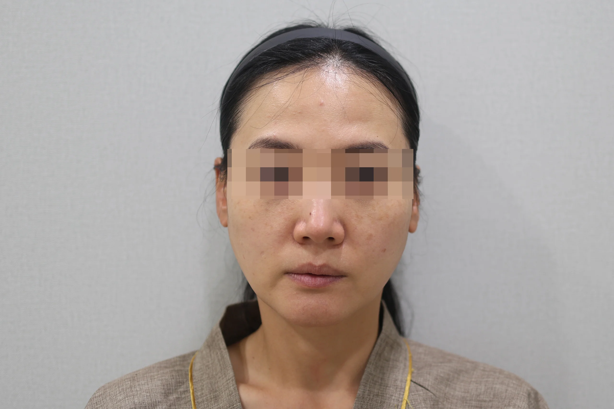 1 frontal view before XERF treatment